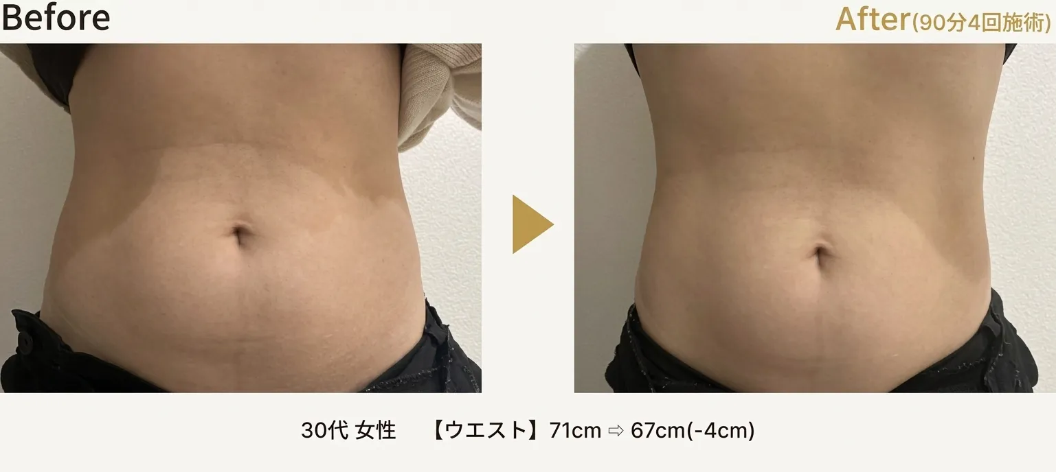 脂肪溶解エステ施術例