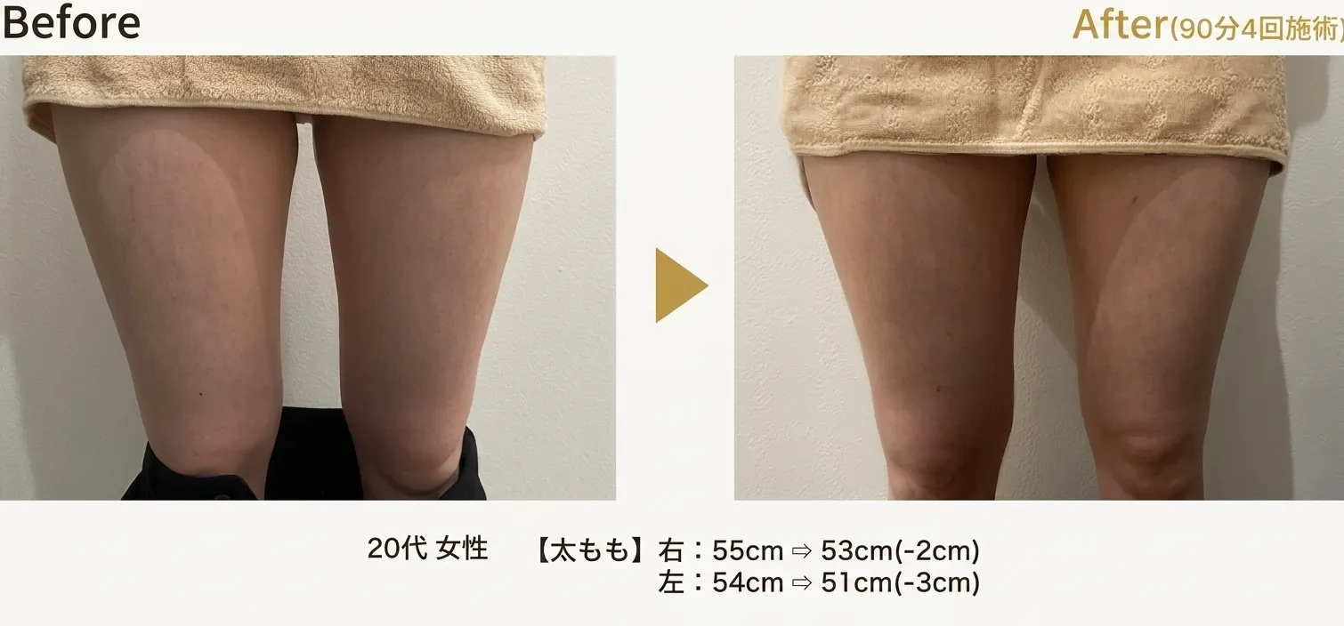 脂肪溶解エステ施術例