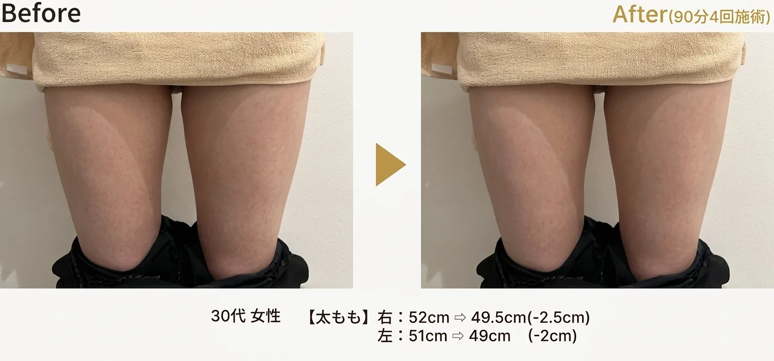 脂肪溶解エステ施術例